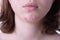 Inflammatory acne spilled out on the chin of a teen girl