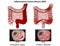Inflammatory bowel disease medical  illustration on white background