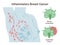 Inflammatory breast cancer. Detailed breast medical anatomy.