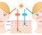 Infographic illustration of difference between UVA and UVB rays.  UV penetration into human skin and white woman face. skin care