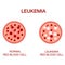 Infographic image of leukemia. Leukaemia disease awareness.Realistic vector