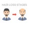 Information chart of hair loss stages types of baldness illustrated on male head vector.