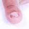 Ingrown nail