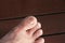 Ingrown nail Big toe selective focus, broken toenail on wood floor