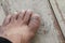 Ingrown nail Big toe selective focus, broken toenail on wooden f