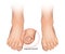 Ingrown toenail or onychocryptosis that occurs when the nail edge grows into the periungual dermis. Nail disease. Vector