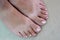 Ingrown toenails on a woman`s foot pain in the big toe closeup