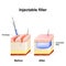 Injectable cosmetic filler. How it works