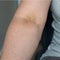 an injection mark in a vein on the arm of an elderly woman..