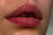 Injections, Plastic Surgery, Collagen and Beauty Treatments. Lip balm. Lipcare lipstick. Close-up of sexy lips.