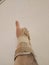Injured hand of an optimistic patient with orthosis raising thumb