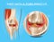 Injured Knee Joint with Torn Meniscus Vector Chart