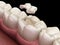 Inlay ceramic crown fixation over tooth. Medically accurate 3D illustration of human teeth