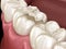 Inlay ceramic crown fixation over tooth. Medically accurate 3D illustration of human teeth