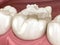 Inlay ceramic crown fixation over tooth. Medically accurate 3D illustration of human teeth