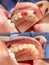 Installation of fiberglass bridge on the teeth using photopolymer restoration material close-up. The concept of aesthetic