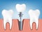 Installing a dental implant a realistic 3D vector illustration
