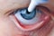 Instill eyedrops or ointment on eye