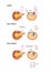 Insulin action and diabetes type 1 and 2, 2d 3d graphic, render