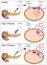 Insulin action and diabetes types