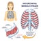 Intercostal muscle strain as muscular group in chest cavity outline diagram