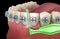 Interdental tooth brush and braces cleaning. Medically accurate 3D illustration of oral hygiene