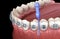 Interdental tooth brush and braces cleaning. Medically accurate illustration of oral hygiene