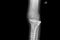 Internal of left leg fixed with plate and screws