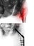 Intertrochanteric fracture femur thigh bone . X-ray of hip and comparison between before surgery upper image and after surger