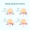 Intervertebral disc herniation, patient-friendly diagra, cross section