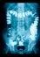 Intestinal abdominal xray