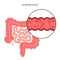 intestine ulcerative colitis