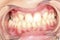 Intra-oral picture of teeth and gum in the smile mouth oral care. Bacteria, dental plaque is the cause of gingivitis and tooth