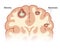 Intracerebral abscess vector