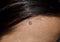 Intradermal nevus or single mole at the forehead of Southeast Asian, Myanmar young woman