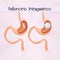 Intragastric balloon