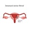 Intramural uterine fibroids. Endometriosis. Infographics. Vector illustration on white background