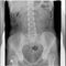 Intravenous pyelogram IVP or intravenous urogram IVU. Supine position.