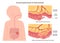 Intussusception. Congenital condition in which part of the intestine