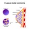 Invasive ductal carcinoma