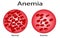 Iron deficiency anemia. Realistic vector 3d picture. Types of anemia. Vector illustration