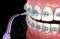 Irrigator cleaning braces with water jet. Medically accurate 3D illustration of oral hygiene