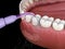 Irrigator, Water teeth cleaning. Medically accurate 3D illustration of oral hygiene