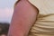 irritated sunburn on womans arm in summer