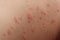 Irritation and rashes on caucasian skin