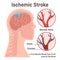Ischemic brain stroke concept. Thrombus in the cerebral artery