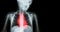 Ischemic Heart Disease , Myocardial Infarction ( MI ) ( Film x-ray body of human with heart disease and blank area at right side )