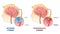 Ischemic vs hemorrhagic head stroke anatomical comparison outline diagram