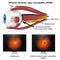 Ishemic optic neuropathy medical 3d illustration on white background
