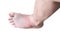 Isolated  asian foot man injured on ankle pain with bruises accident from falling stairs on white background , clipping path